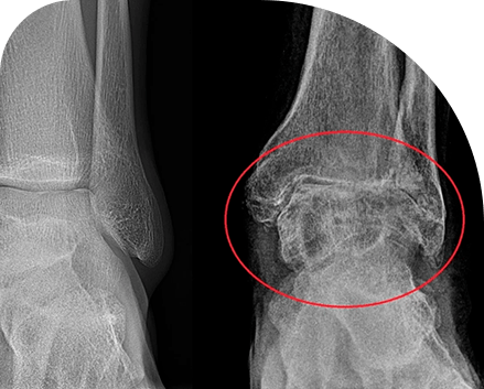 Artrose de Tornozelo: O que é, sintomas e tratamentos