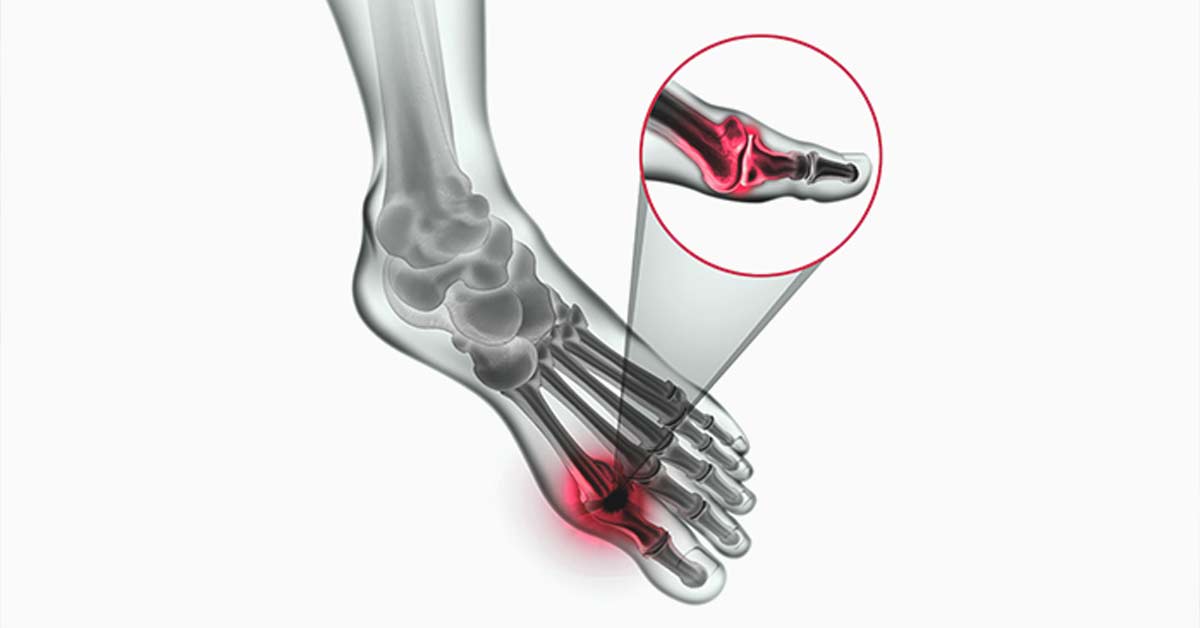 Hálux Rígido (Osteoartrose) Sintomas e tratamentos disponíveis